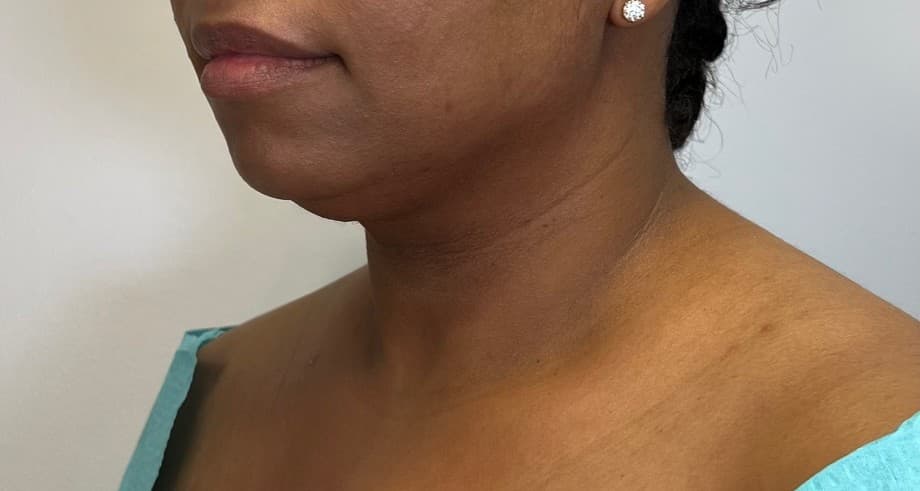 Renuvion J-Plasma Before - Patient 3989 - Front Left View