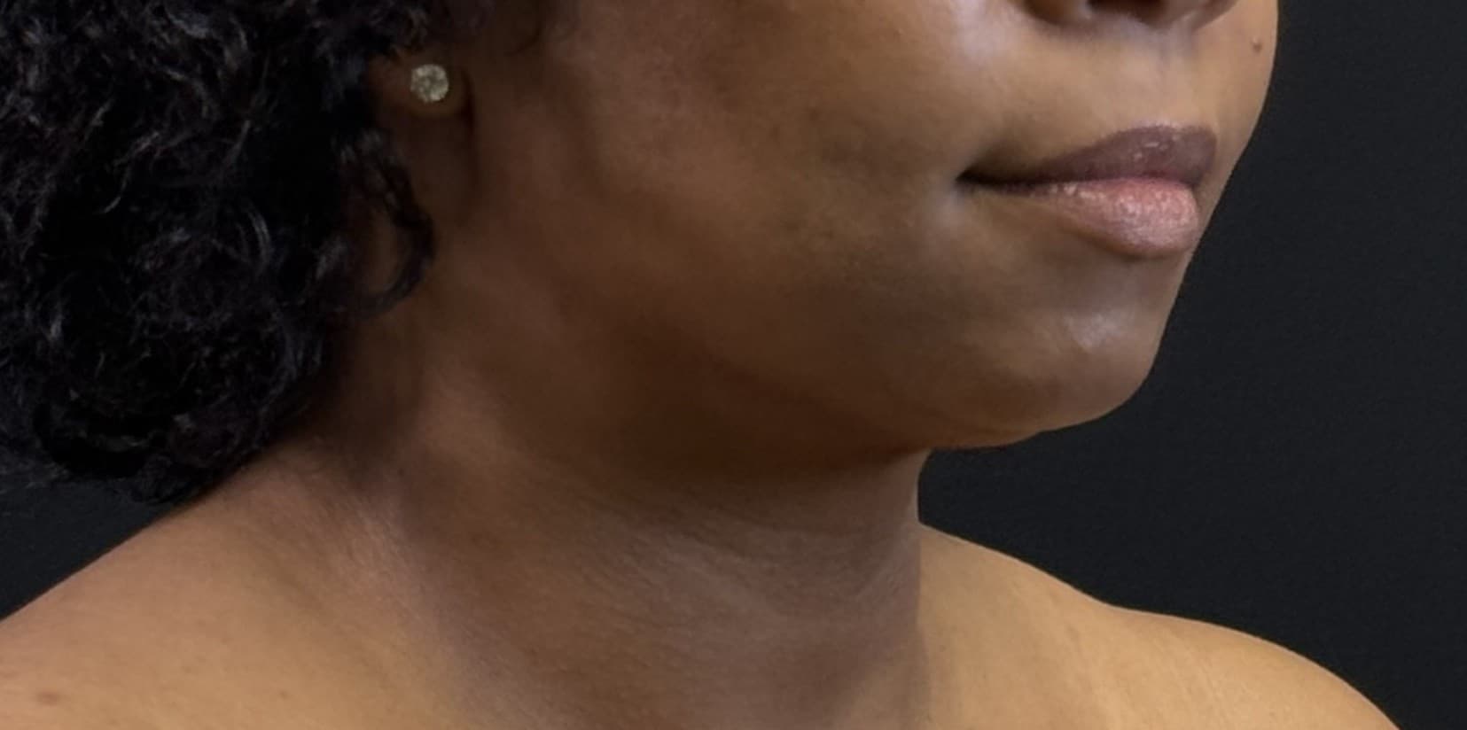 Renuvion J-Plasma After - Patient 3989 - Front Right View