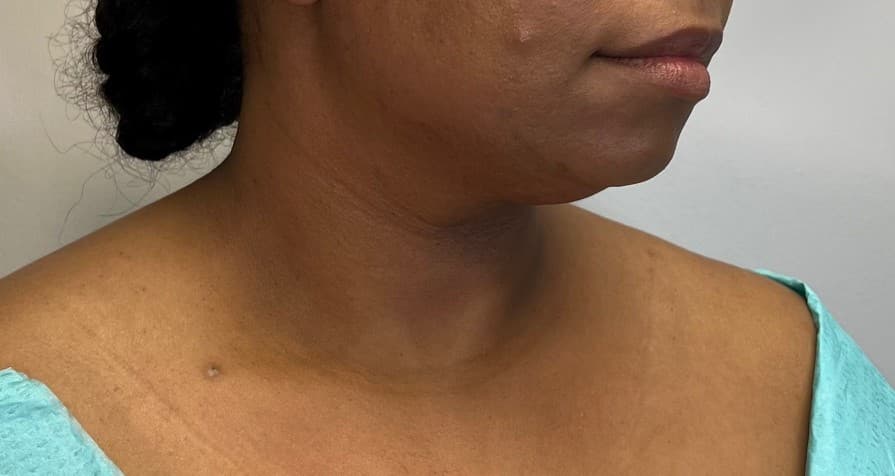 Renuvion J-Plasma Before - Patient 3989 - Front Right View