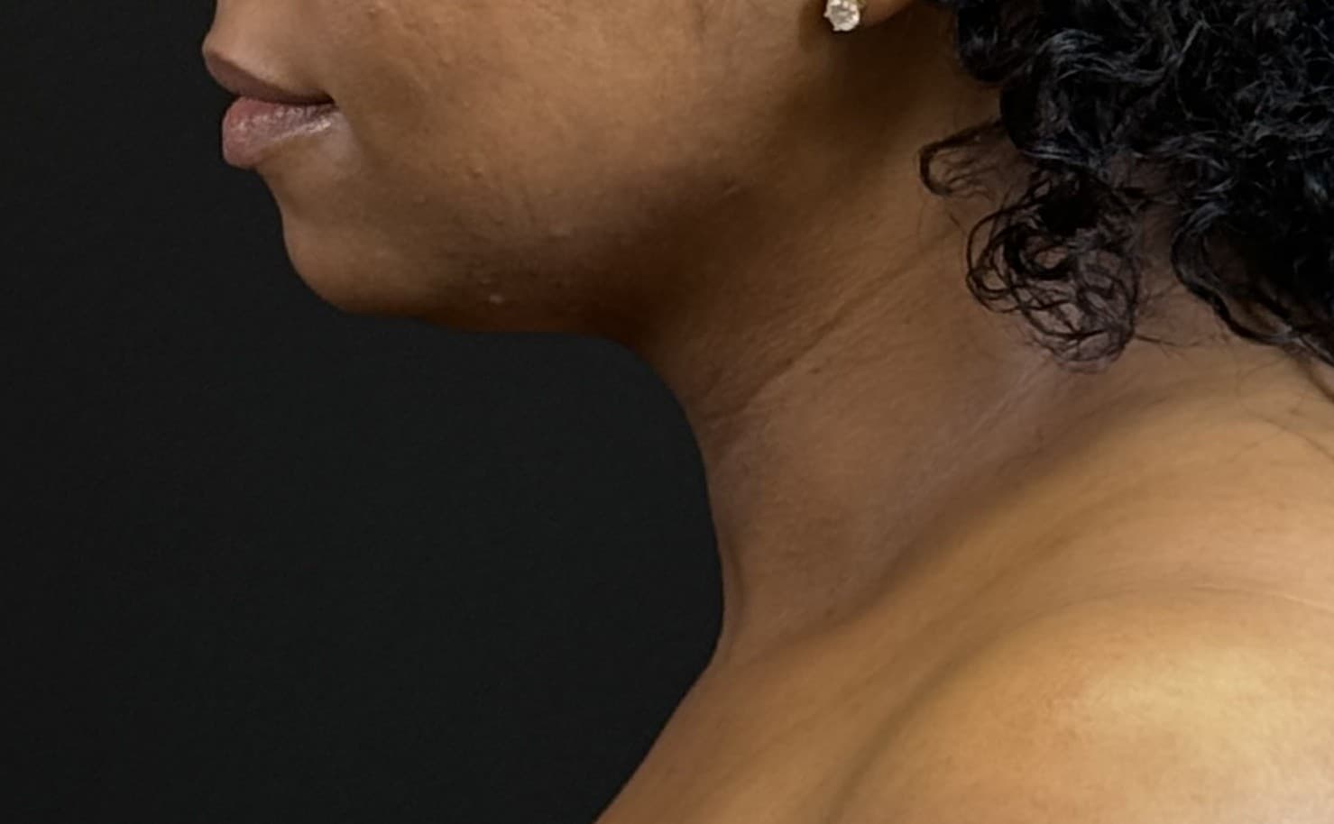 Renuvion J-Plasma After - Patient 3989 - Left View