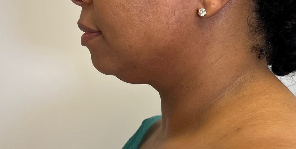 Renuvion J-Plasma Before - Patient 3989 - Left View