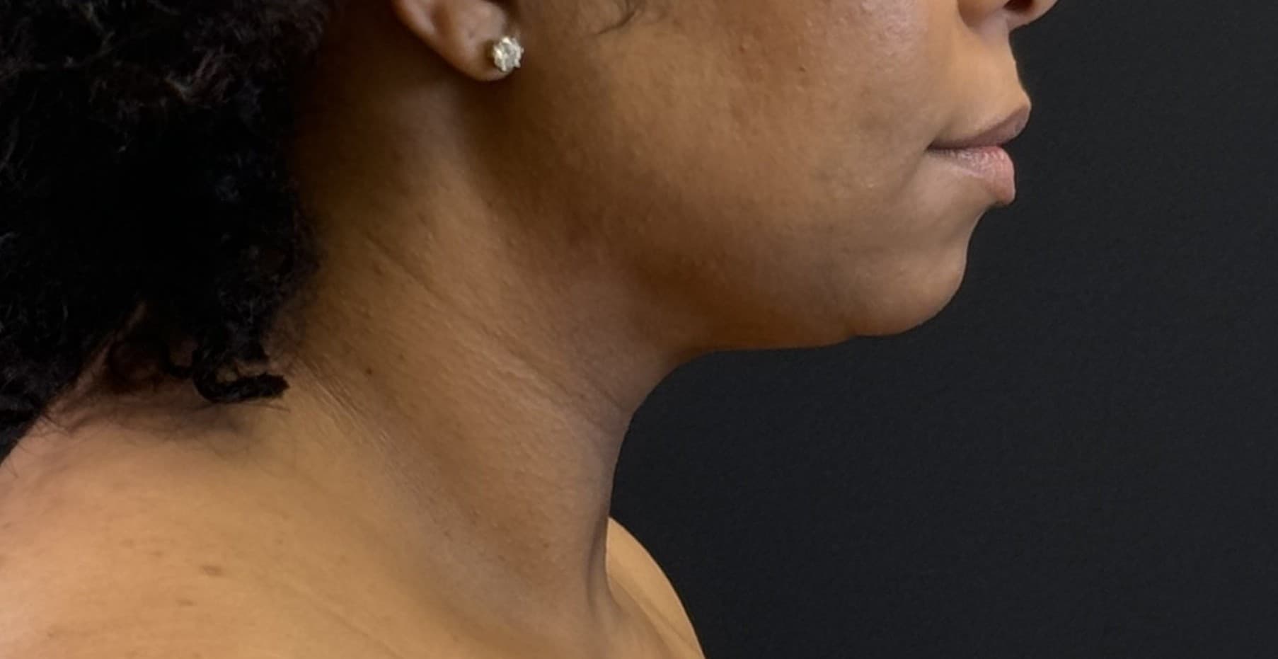 Renuvion J-Plasma After - Patient 3989 - Right View