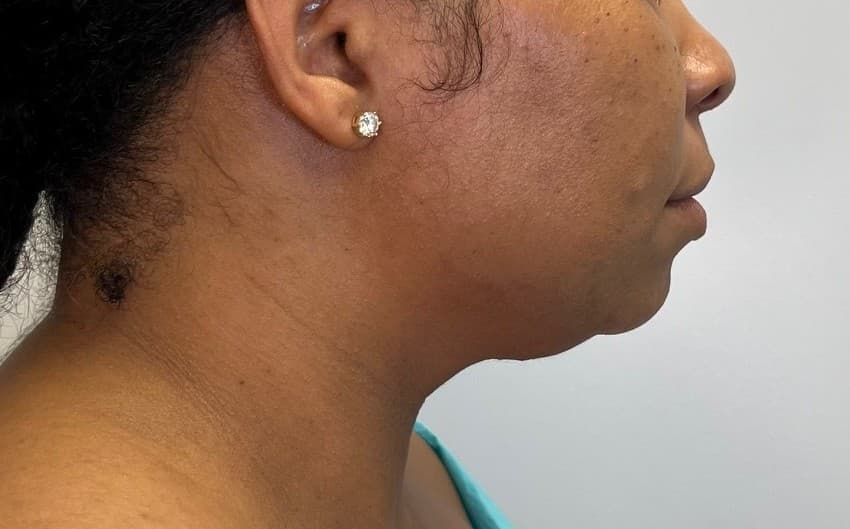 Renuvion J-Plasma Before - Patient 3989 - Right View