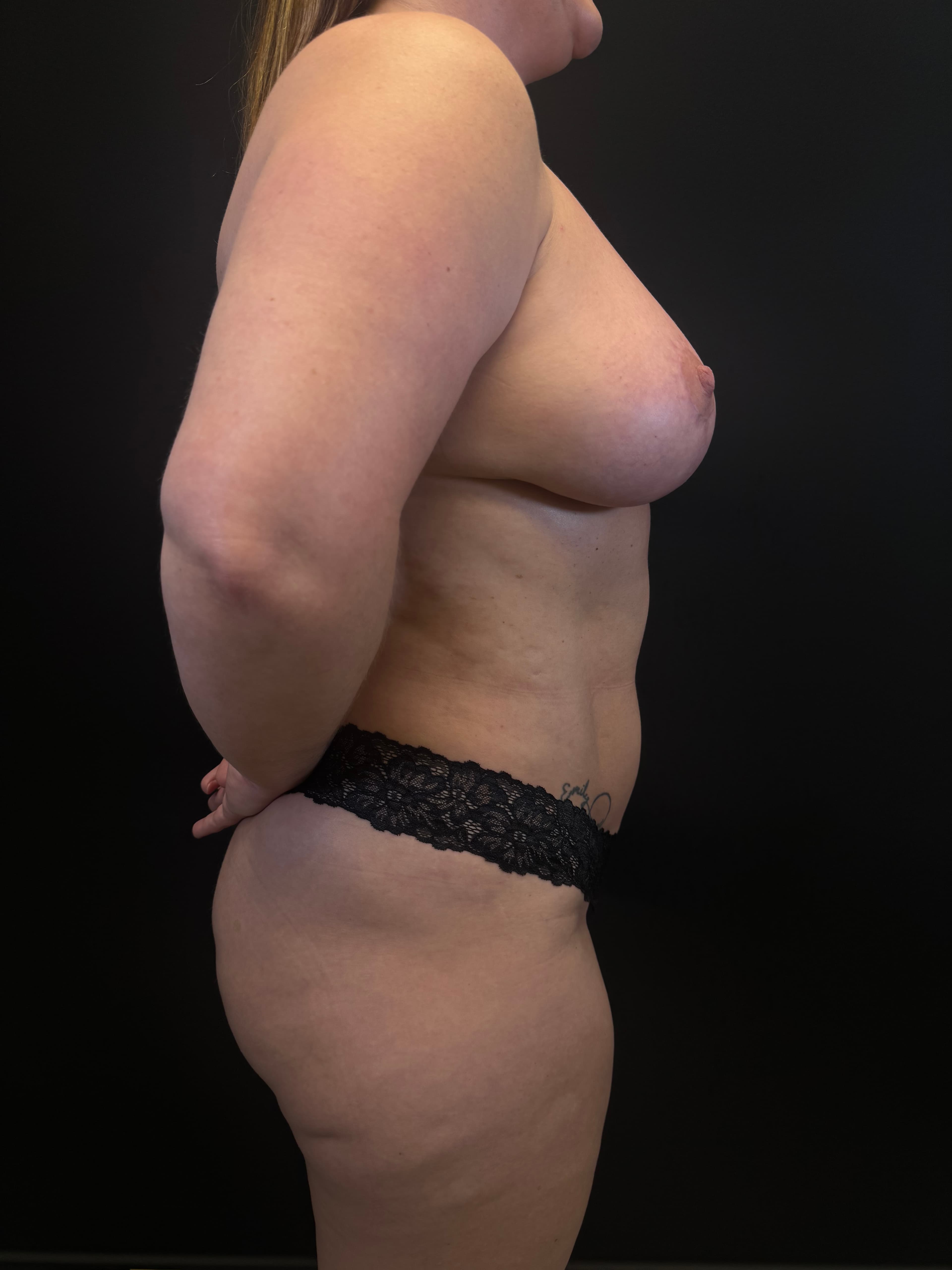 Renuvion J-Plasma After - Patient 5445 - Right View