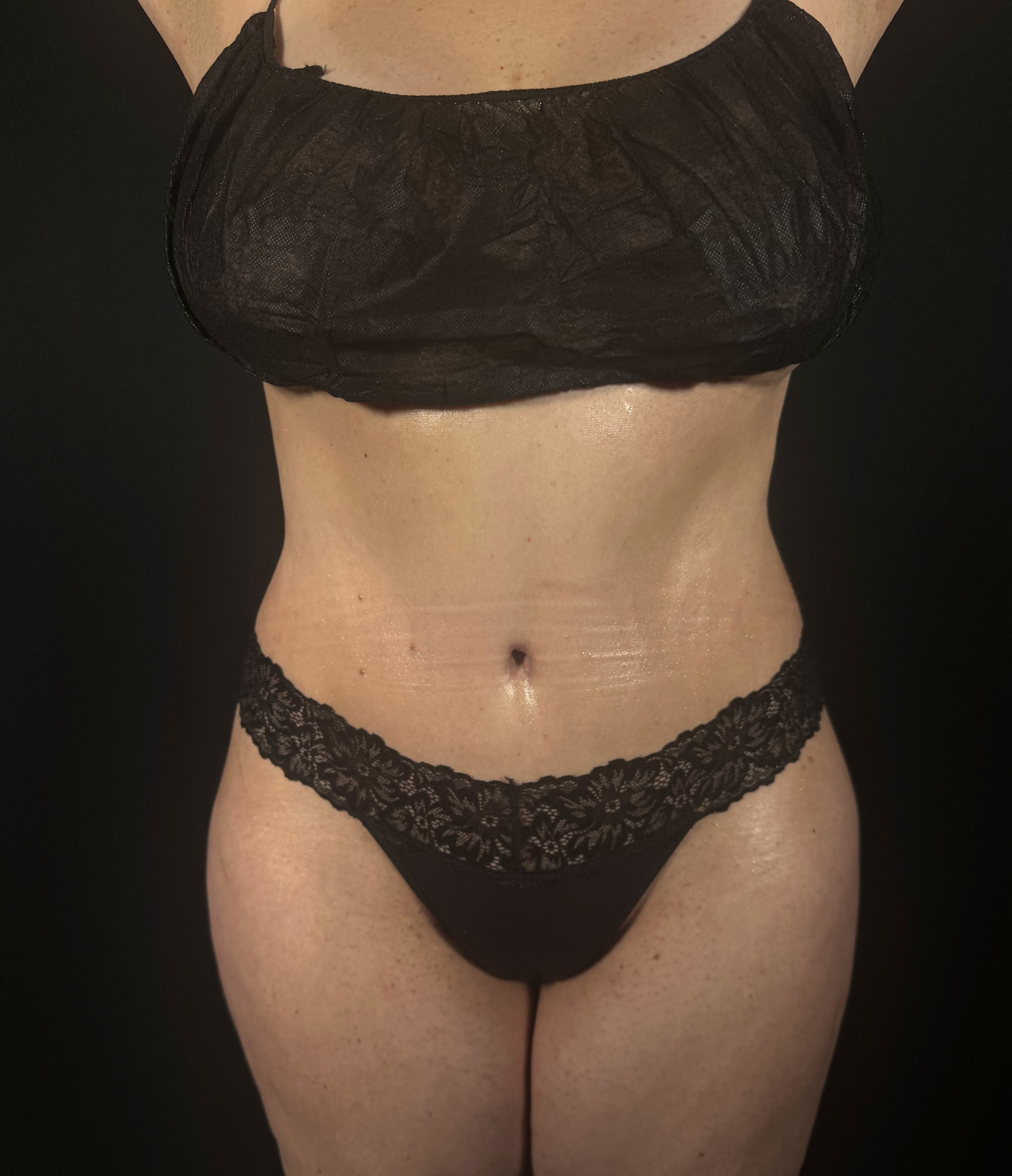 Tummy Tuck After - Patient 2265