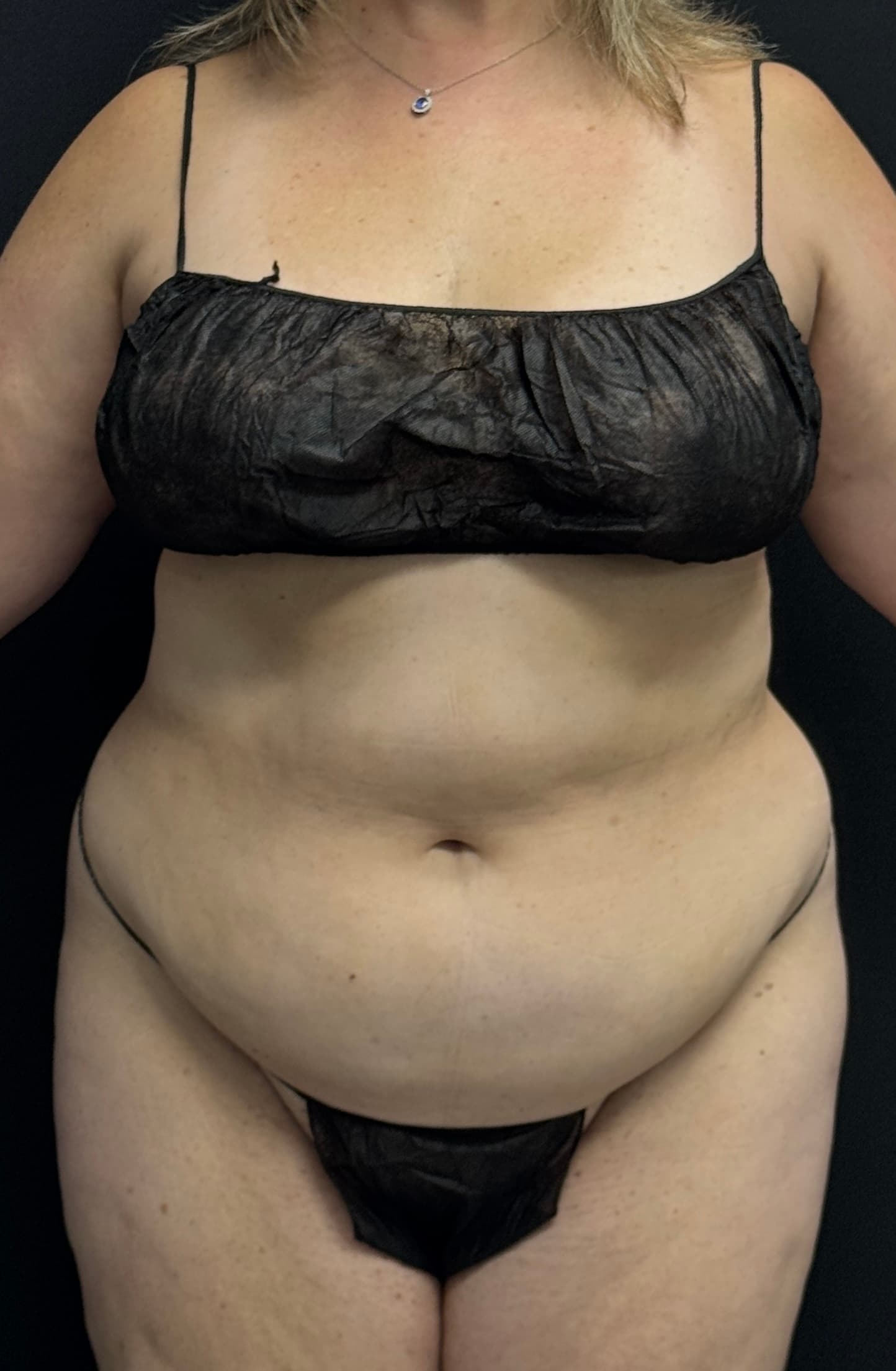 Tummy Tuck Before - Patient 2265