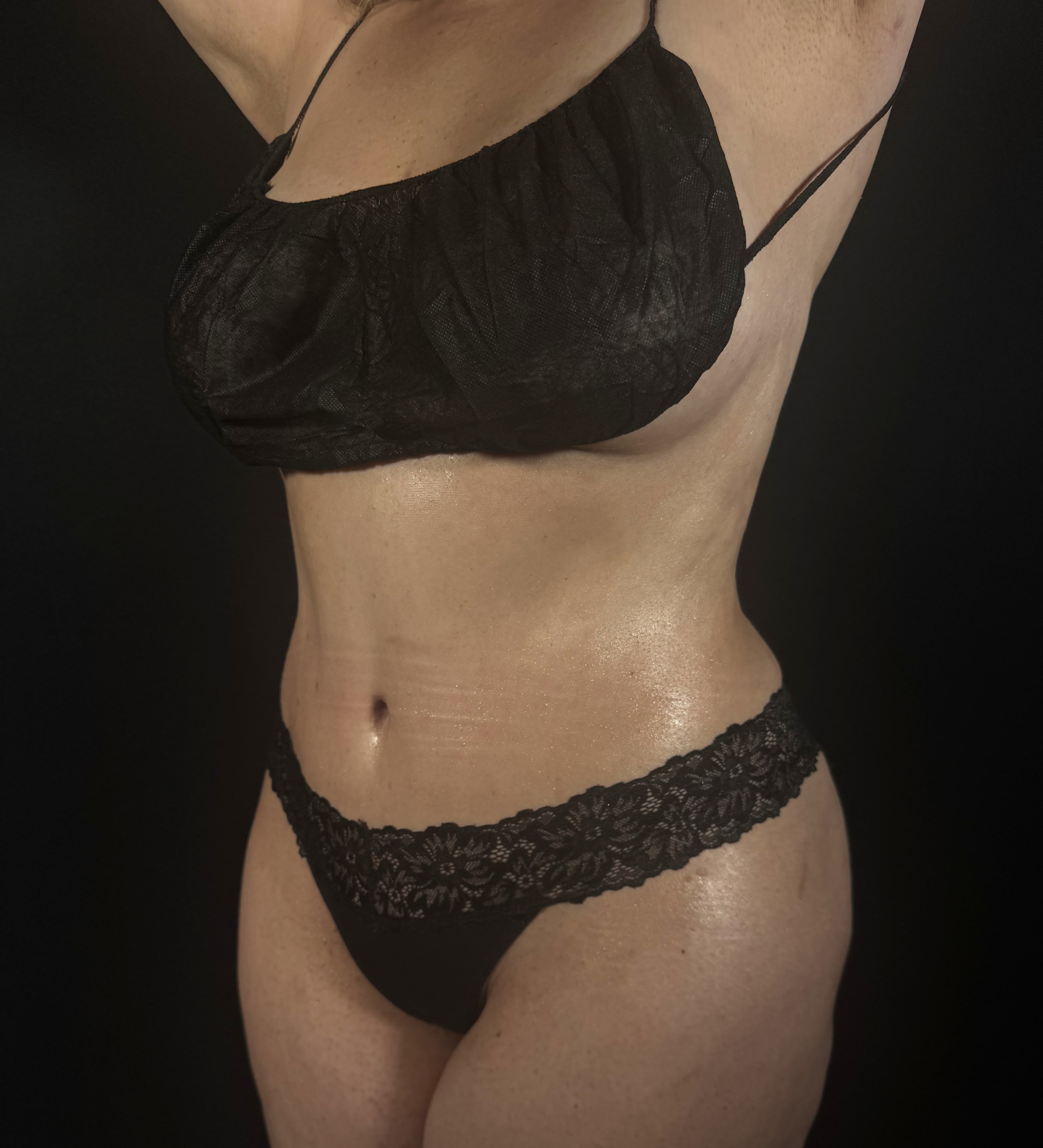 Tummy Tuck After - Patient 2265 - Front Left View