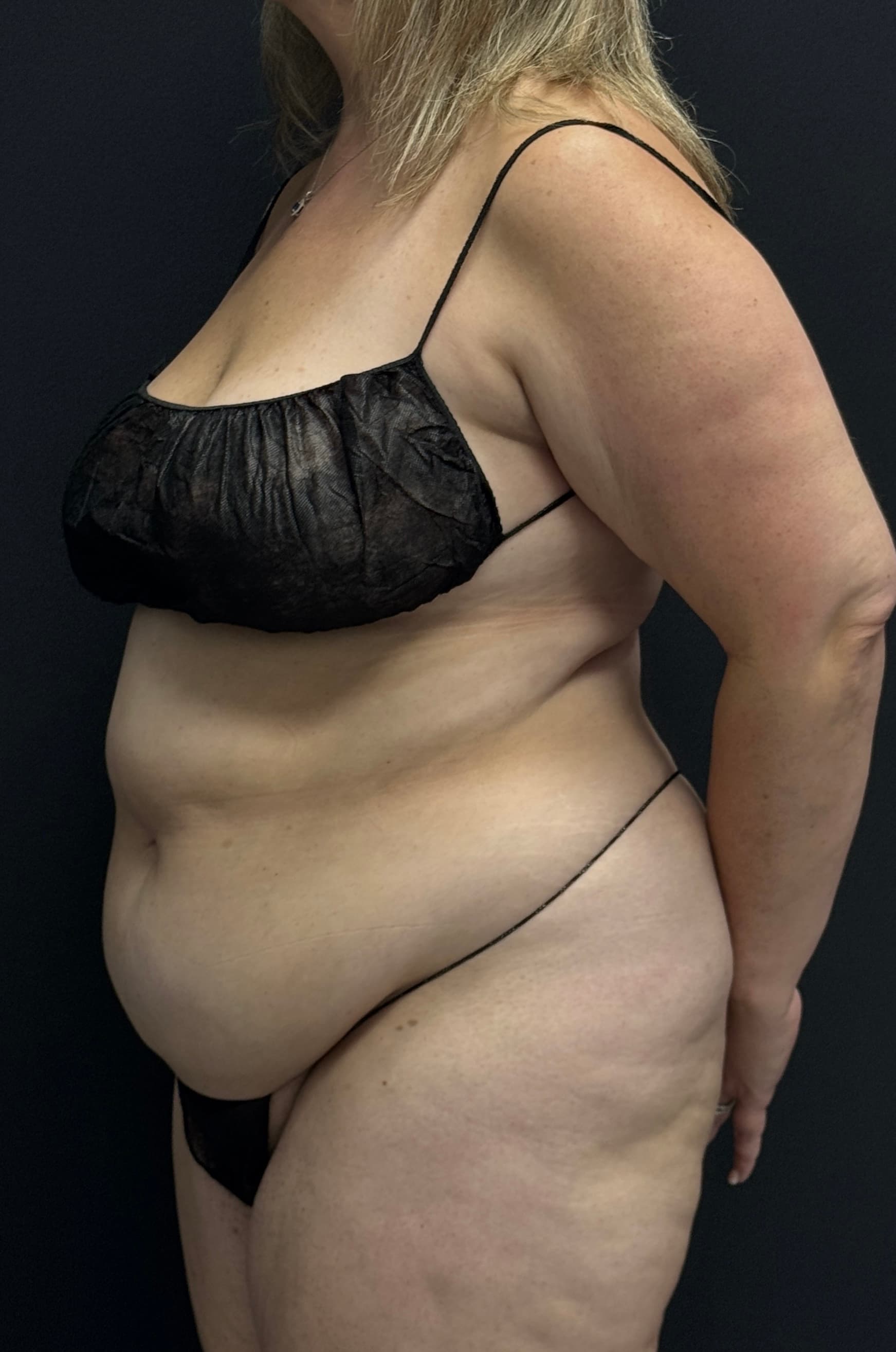 Tummy Tuck Before - Patient 2265 - Front Left View