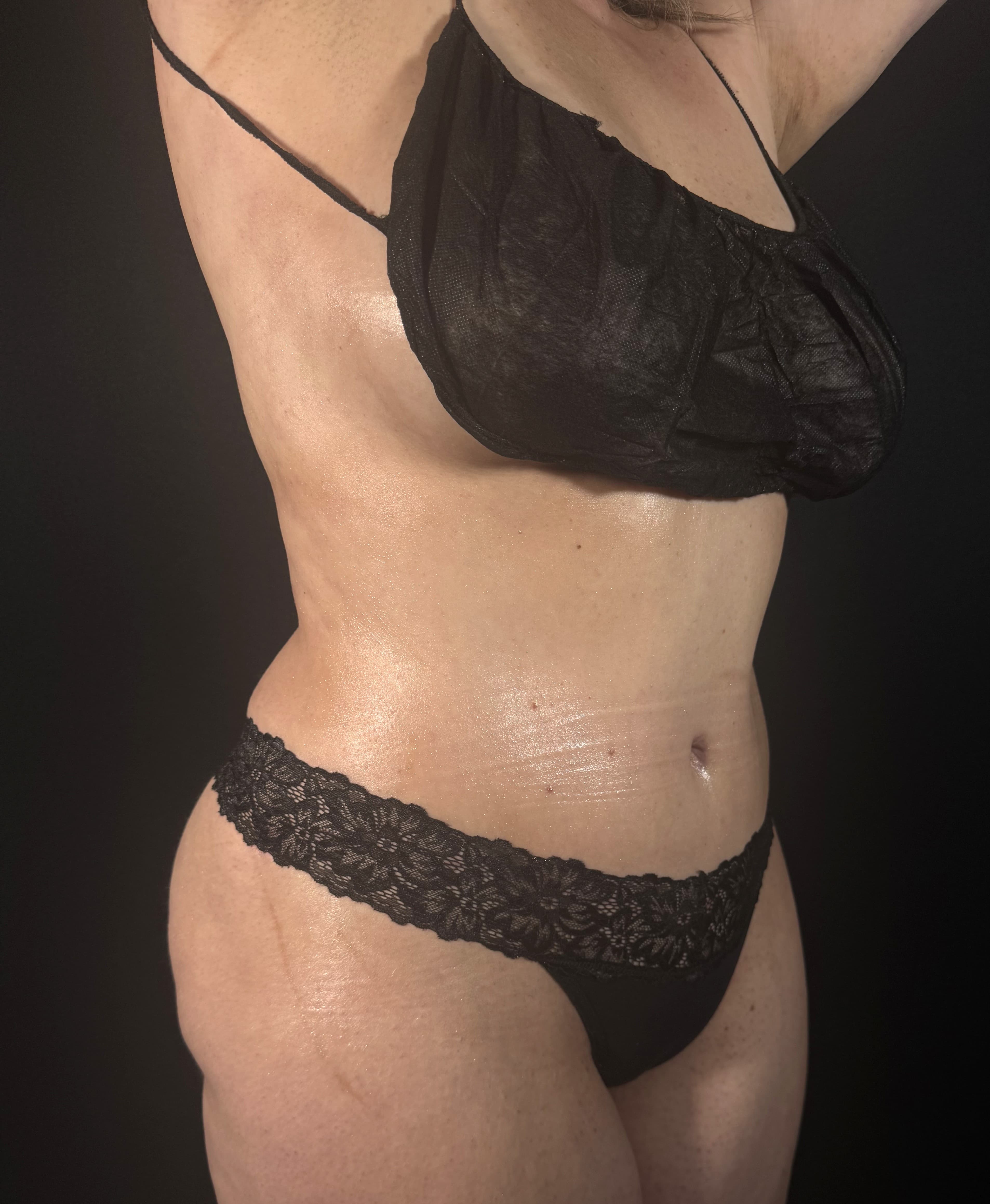 Tummy Tuck After - Patient 2265 - Front Right View