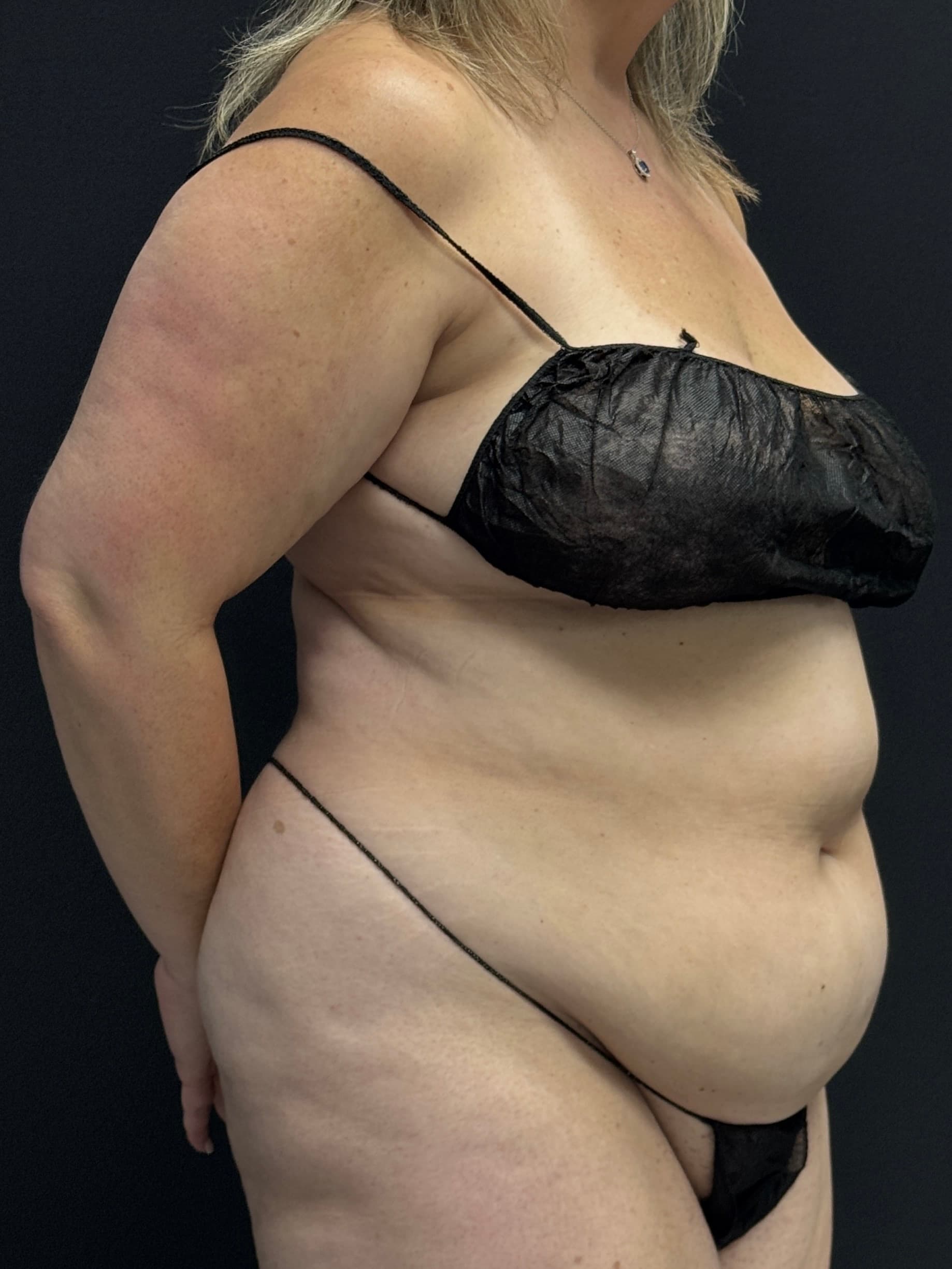 Tummy Tuck Before - Patient 2265 - Front Right View
