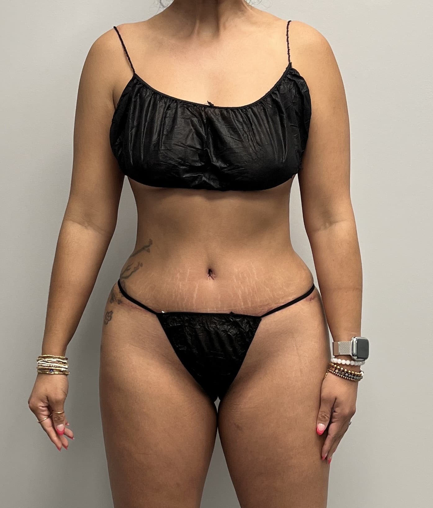 Tummy Tuck After - Patient 3248 - Front View