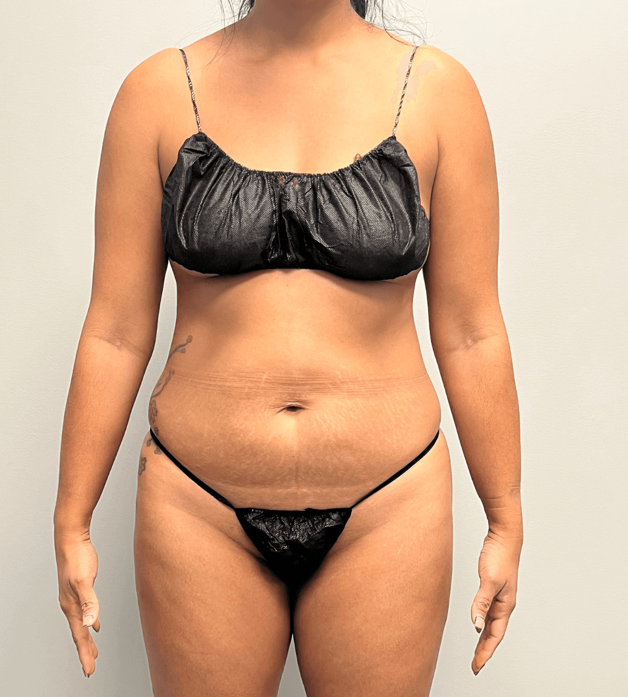 Tummy Tuck Before - Patient 3248 - Front View