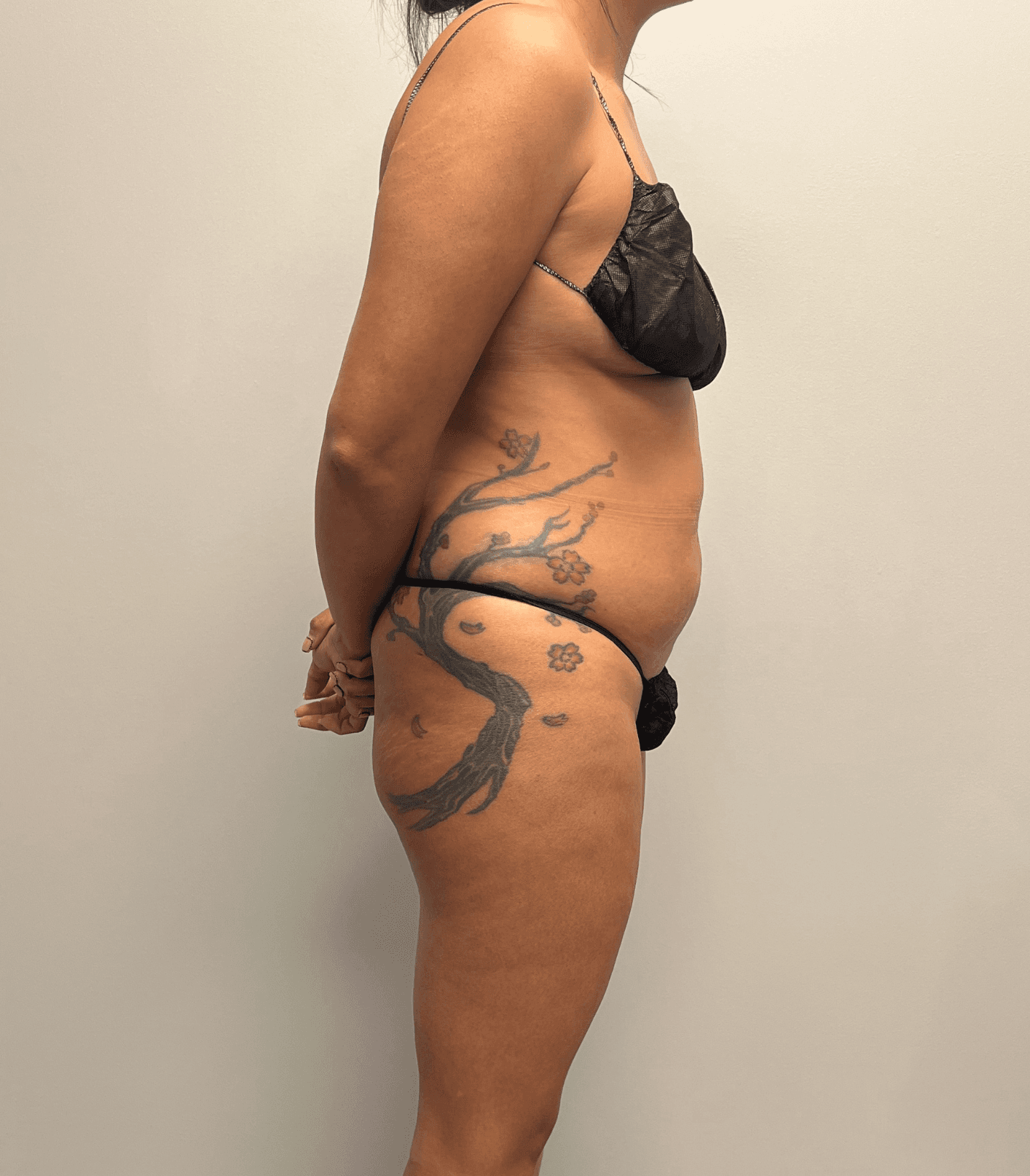 Tummy Tuck Before - Patient 3248 - Right View