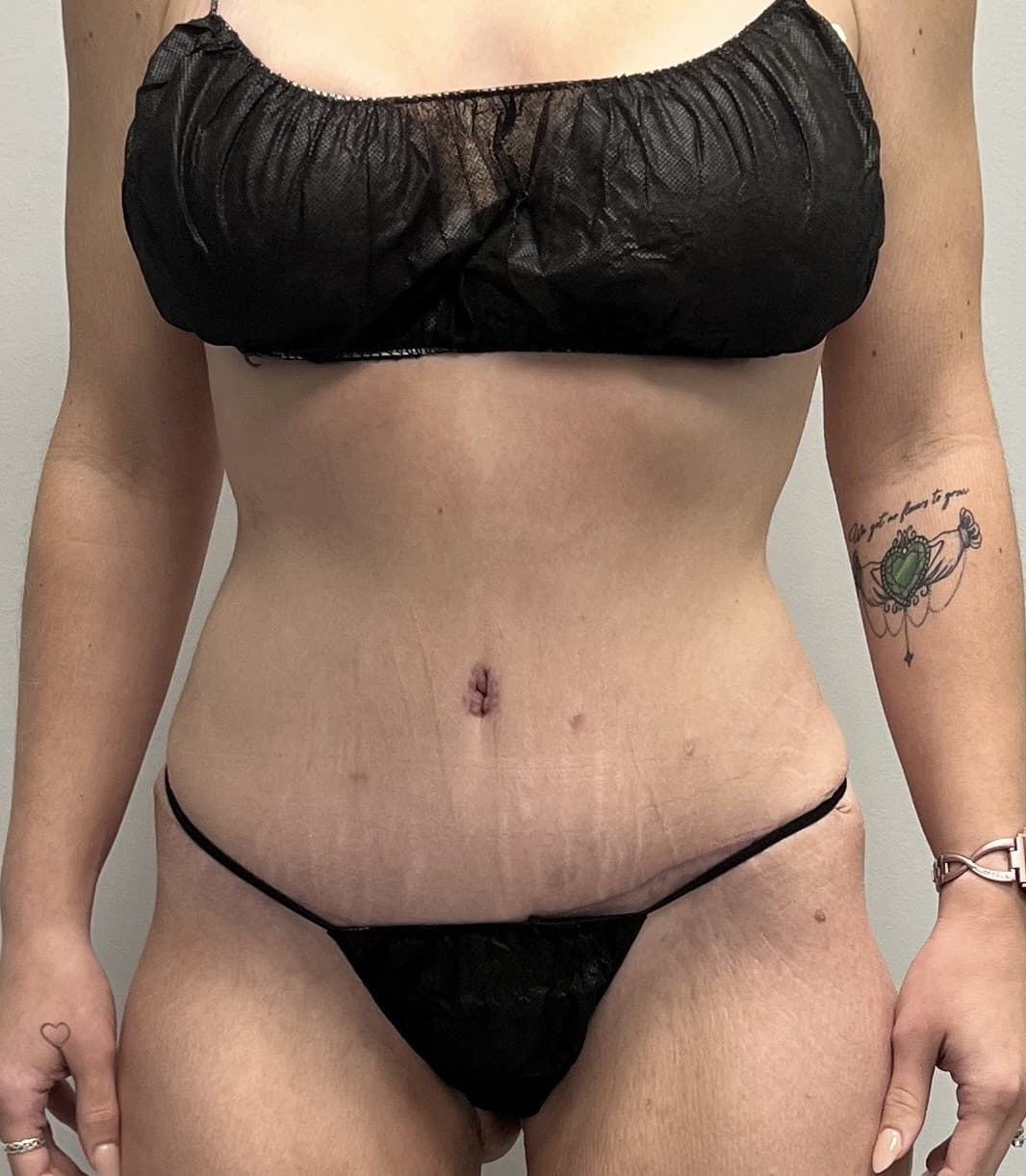 Tummy Tuck After - Patient 3323 - Front View