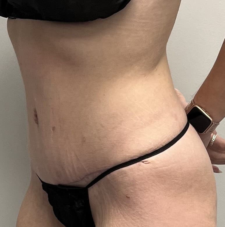 Tummy Tuck After - Patient 3323 - Front Left View