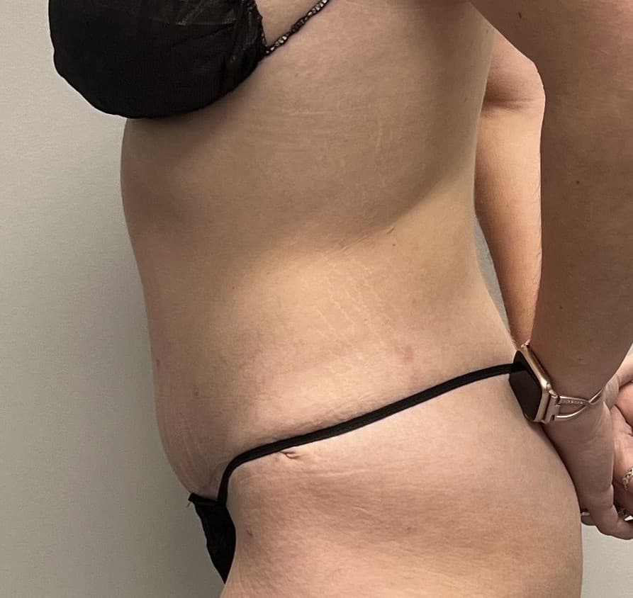 Tummy Tuck After - Patient 3323 - Left View