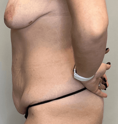 Tummy Tuck Before - Patient 3323 - Left View