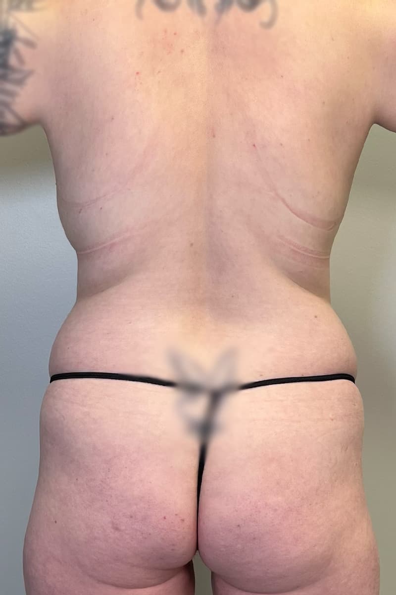 Tummy Tuck Before - Patient 334280 - Back View