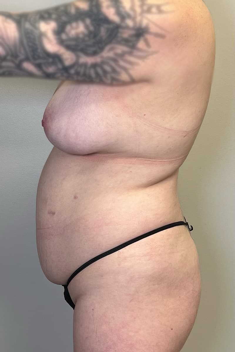 Tummy Tuck Before - Patient 334280 - Left View