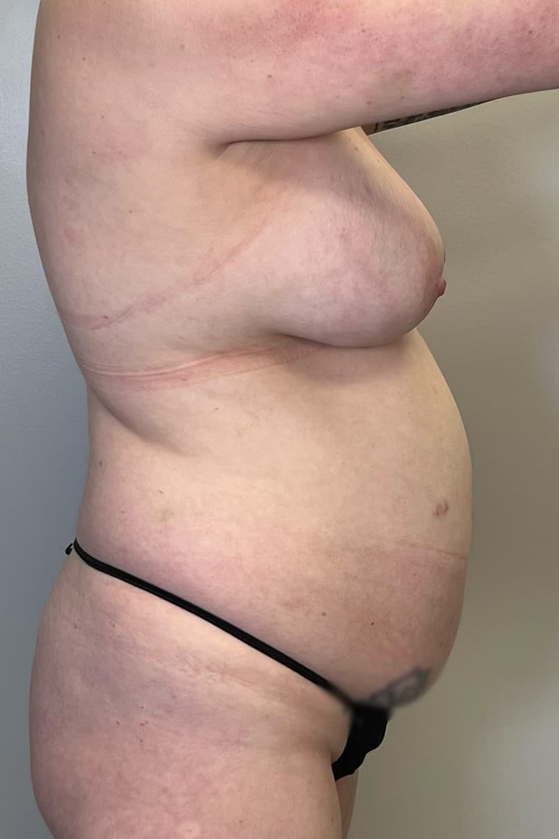 Tummy Tuck Before - Patient 334280 - Right View