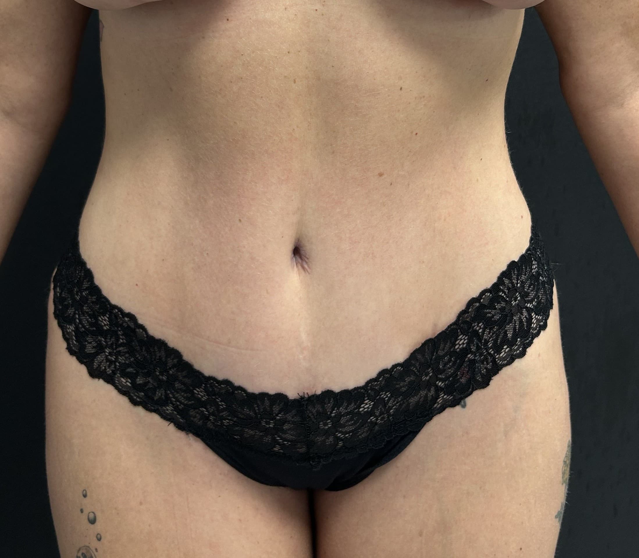 Tummy Tuck After - Patient 5645