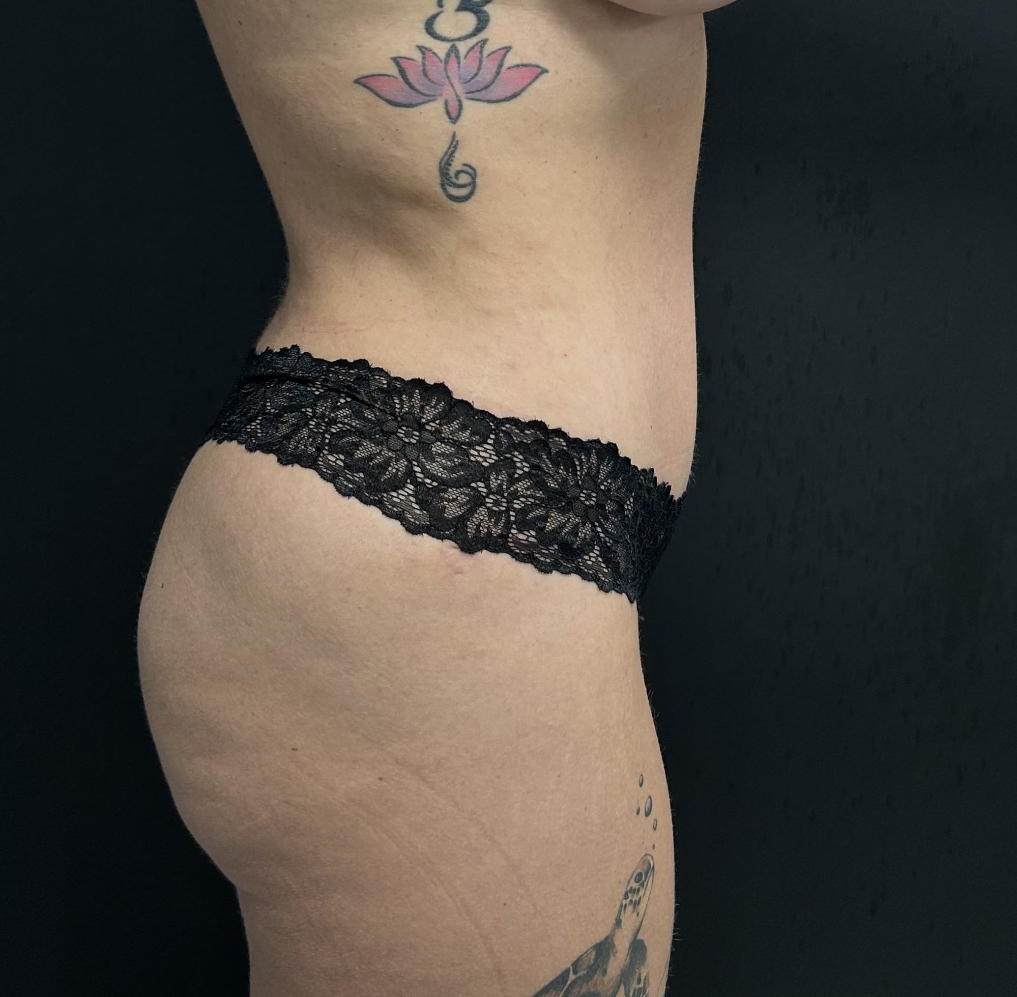 Tummy Tuck After - Patient 5645 - Right View