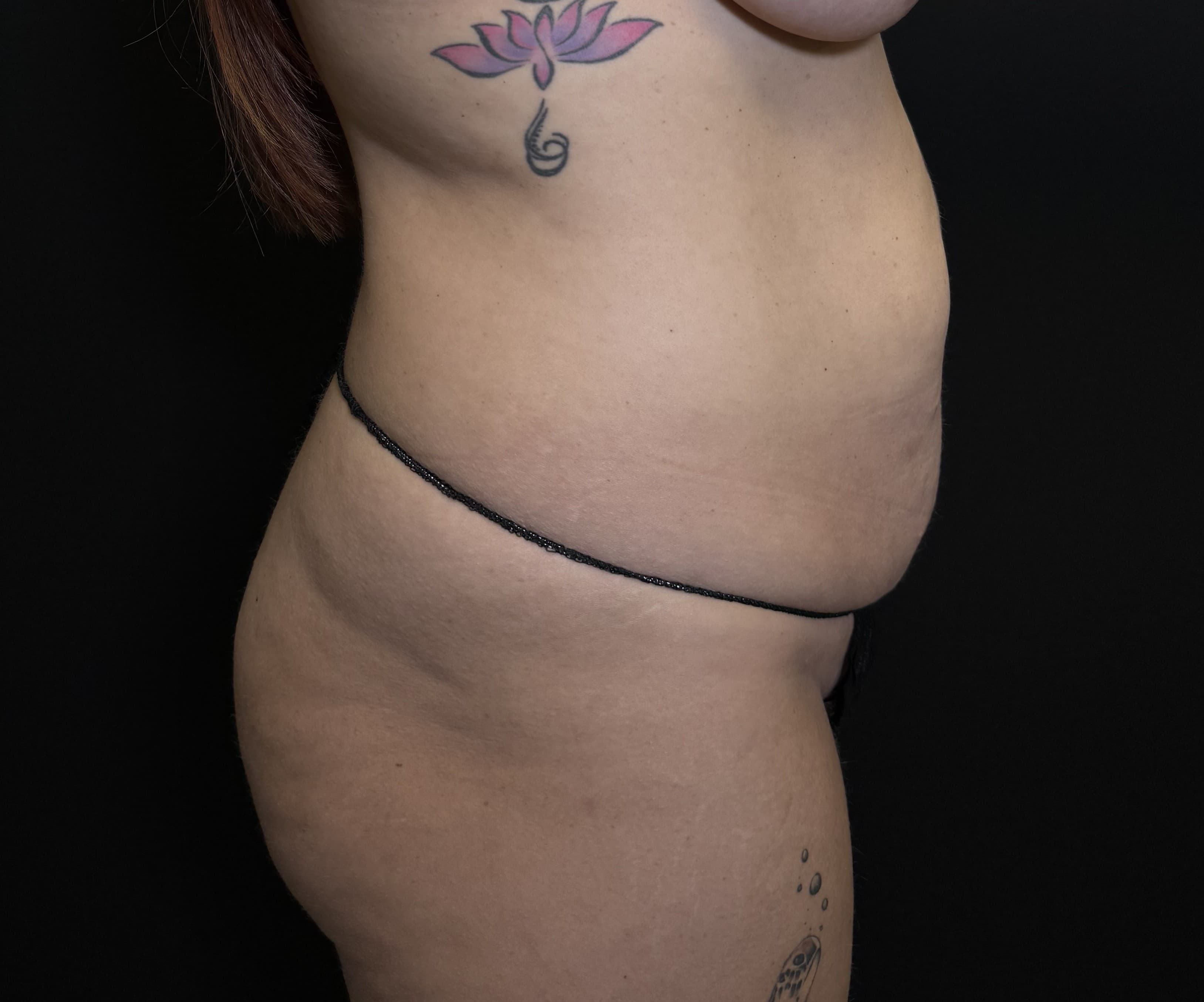 Tummy Tuck Before - Patient 5645 - Right View