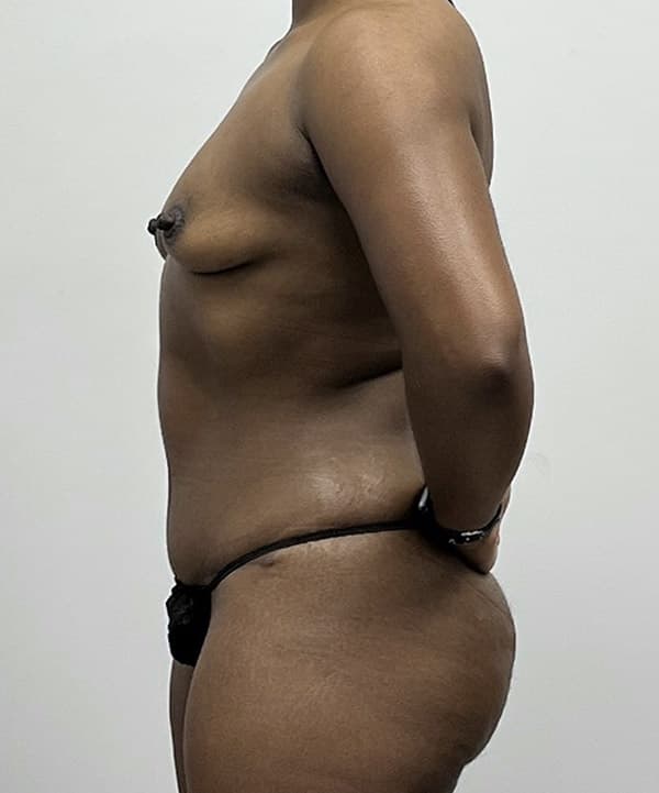 Tummy Tuck After - Patient 93898914 - Left View