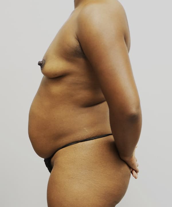 Tummy Tuck Before - Patient 93898914 - Left View