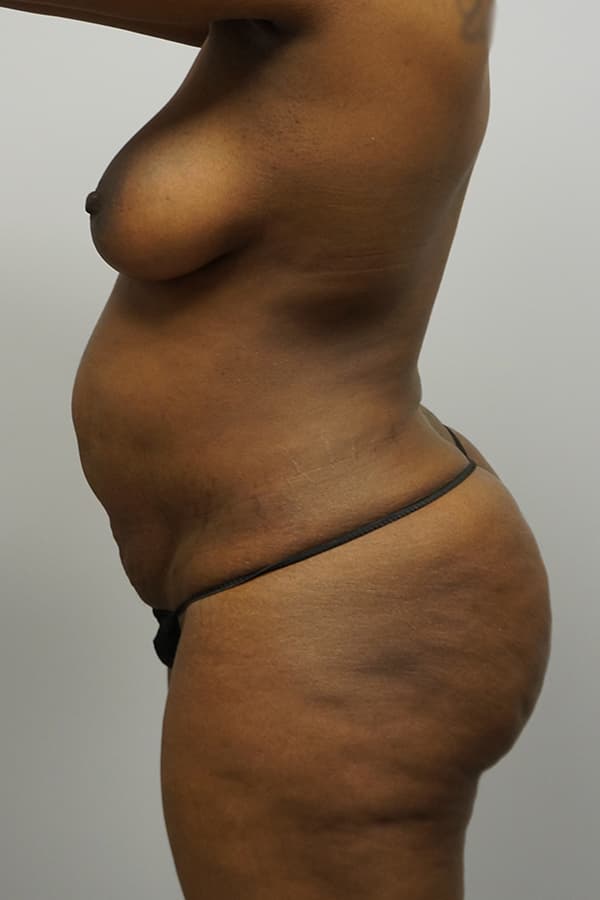 Tummy Tuck Before - Patient 93899002 - Left View