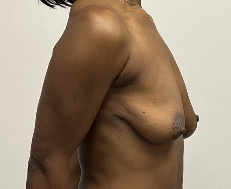 Breast Augmentation with Mastopexy Before - Patient 2517 - Front Right View