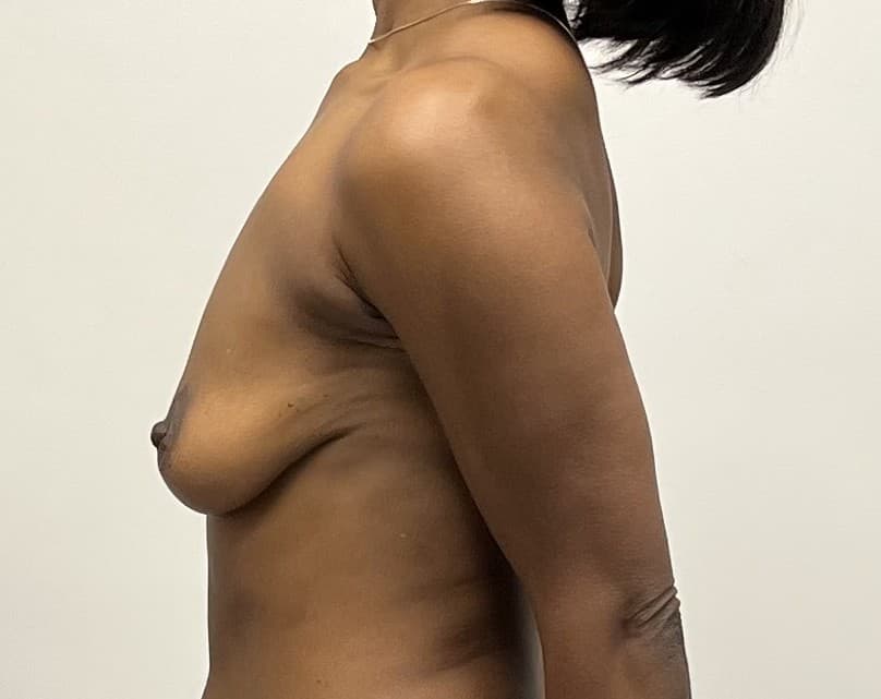 Breast Augmentation with Mastopexy Before - Patient 2517 - Left View