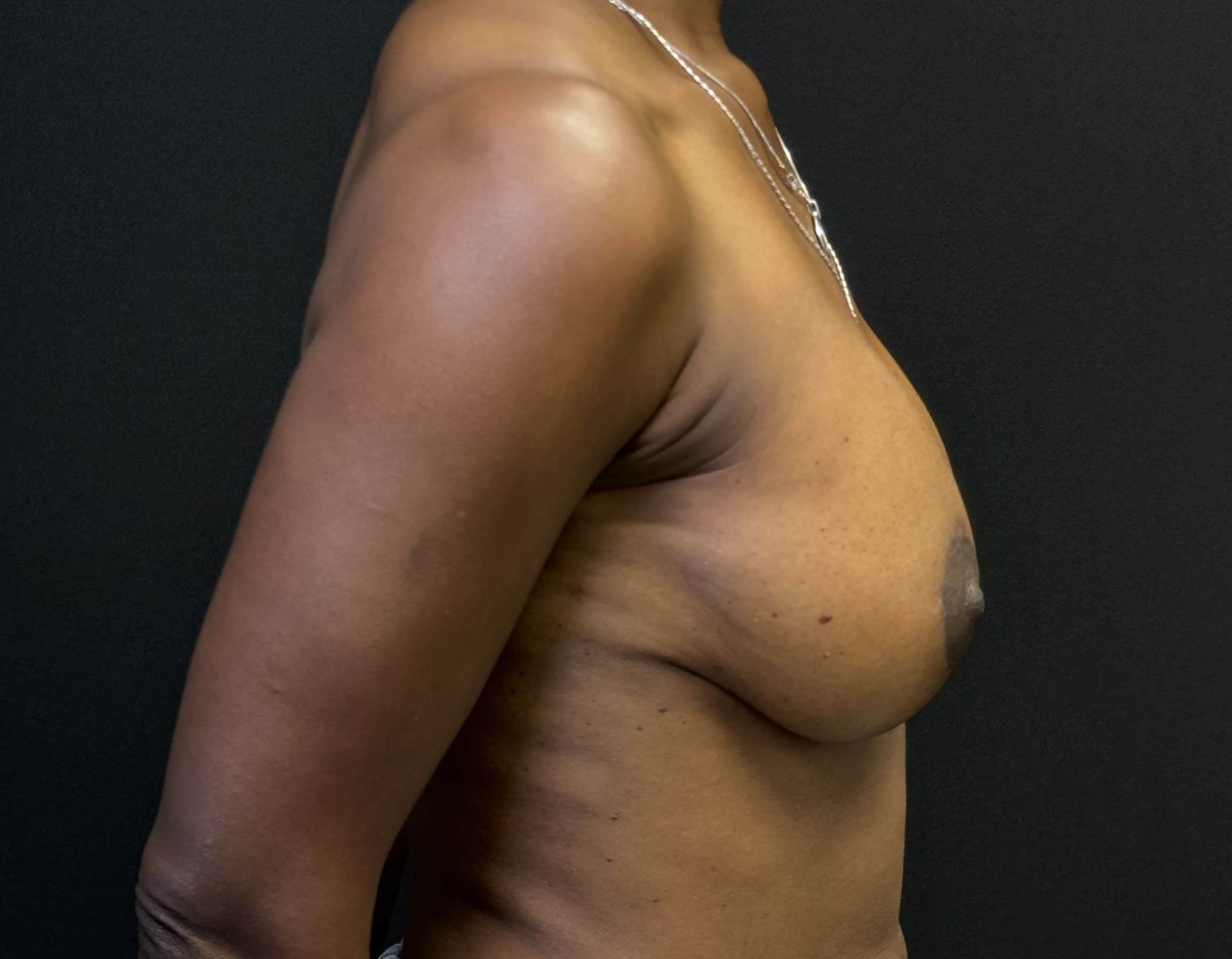 Breast Augmentation with Mastopexy After - Patient 2517 - Right View