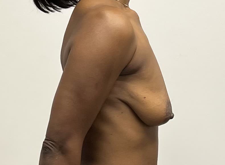 Breast Augmentation with Mastopexy Before - Patient 2517 - Right View