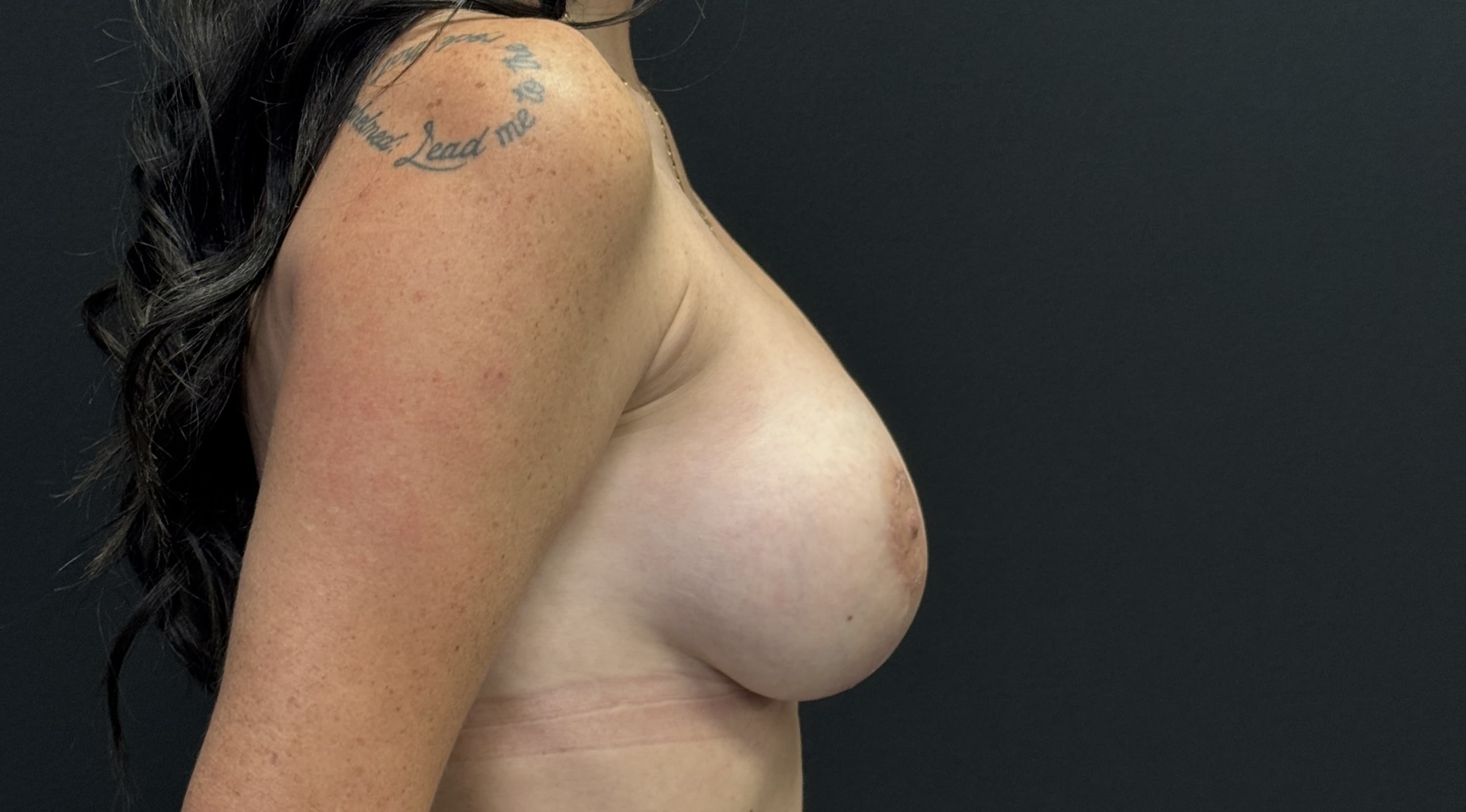 Breast Augmentation with Mastopexy After - Patient 4605 - Right View