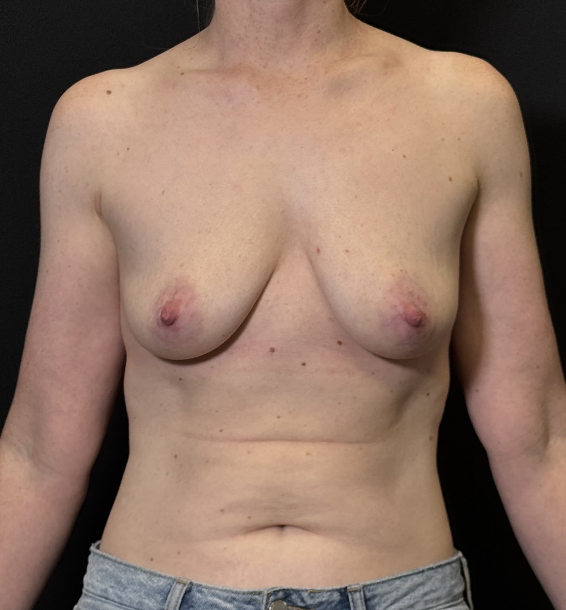 Breast Augmentation with Mastopexy Before - Patient 4615 - Front View