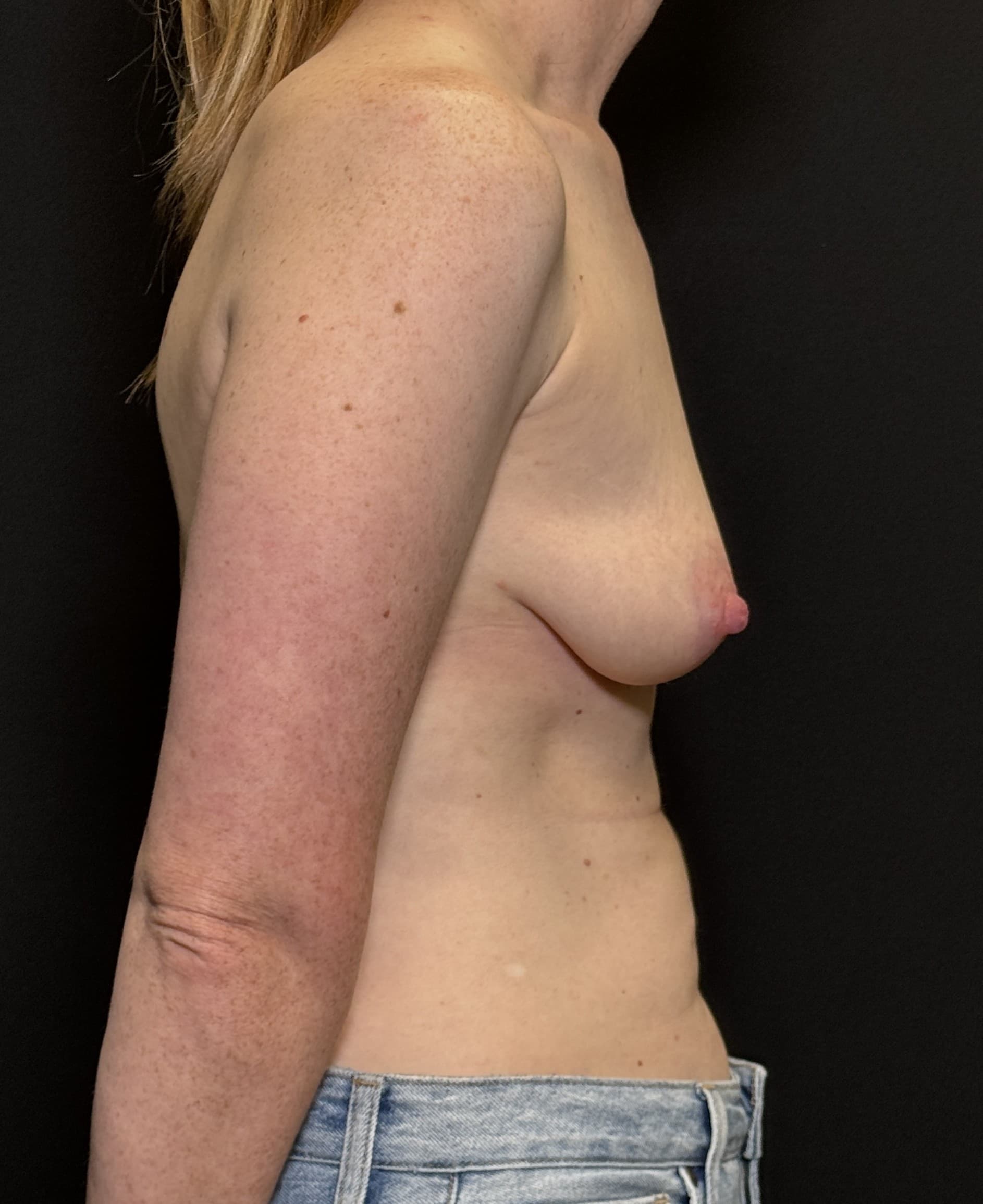 Breast Augmentation with Mastopexy Before - Patient 4615 - Right View