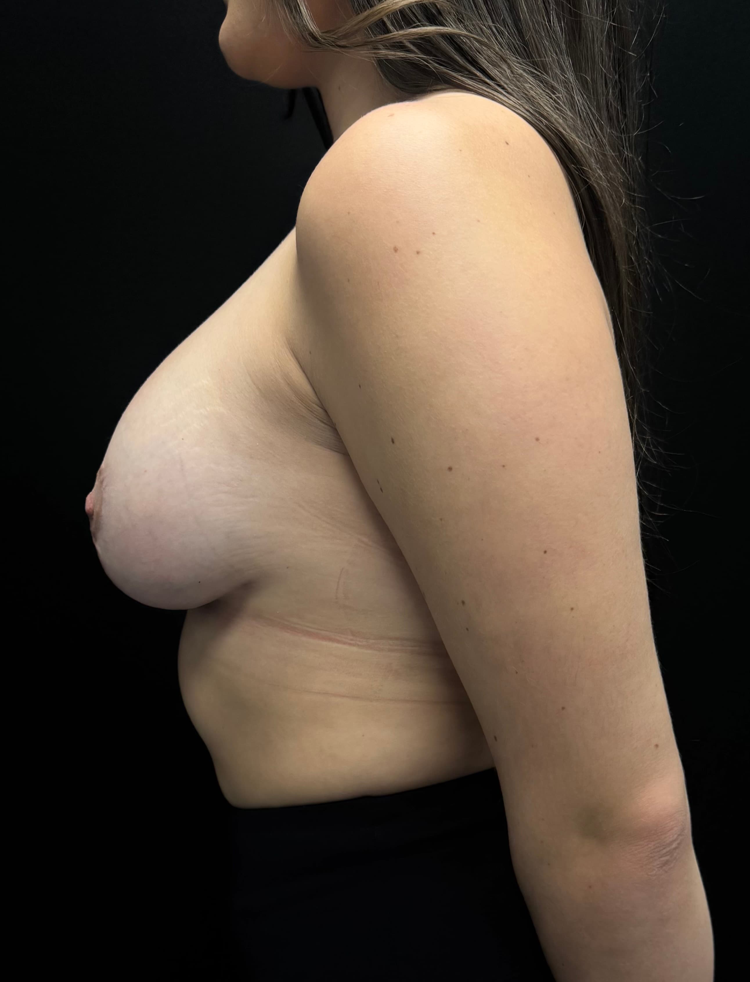 Breast Augmentation with Mastopexy After - Patient 4792 - Left View