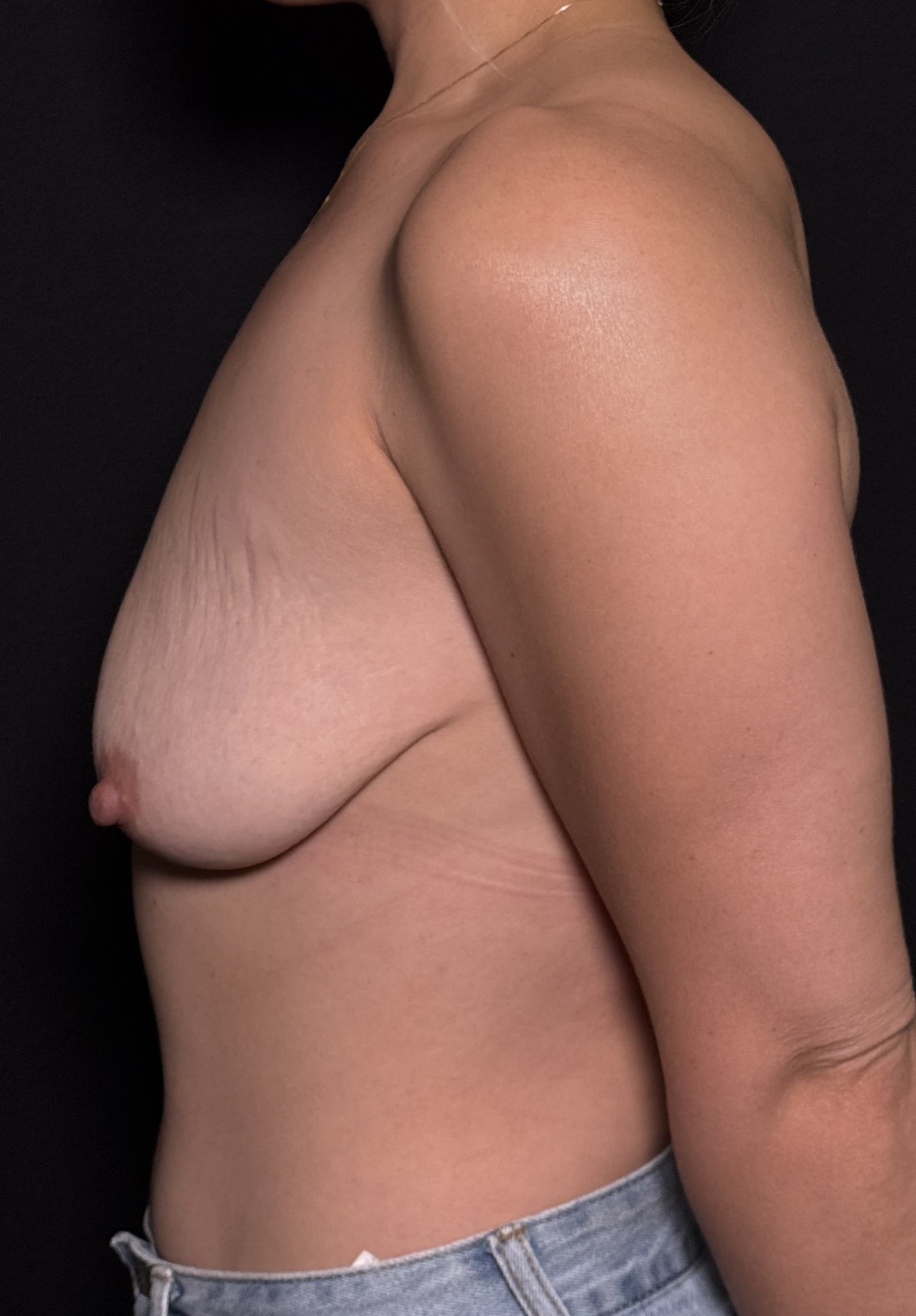 Breast Augmentation with Mastopexy Before - Patient 4920 - Left View