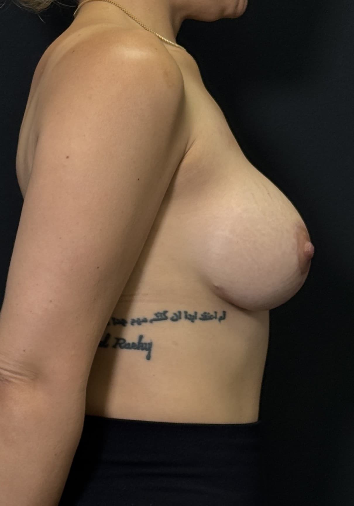 Breast Augmentation with Mastopexy After - Patient 4920 - Right View