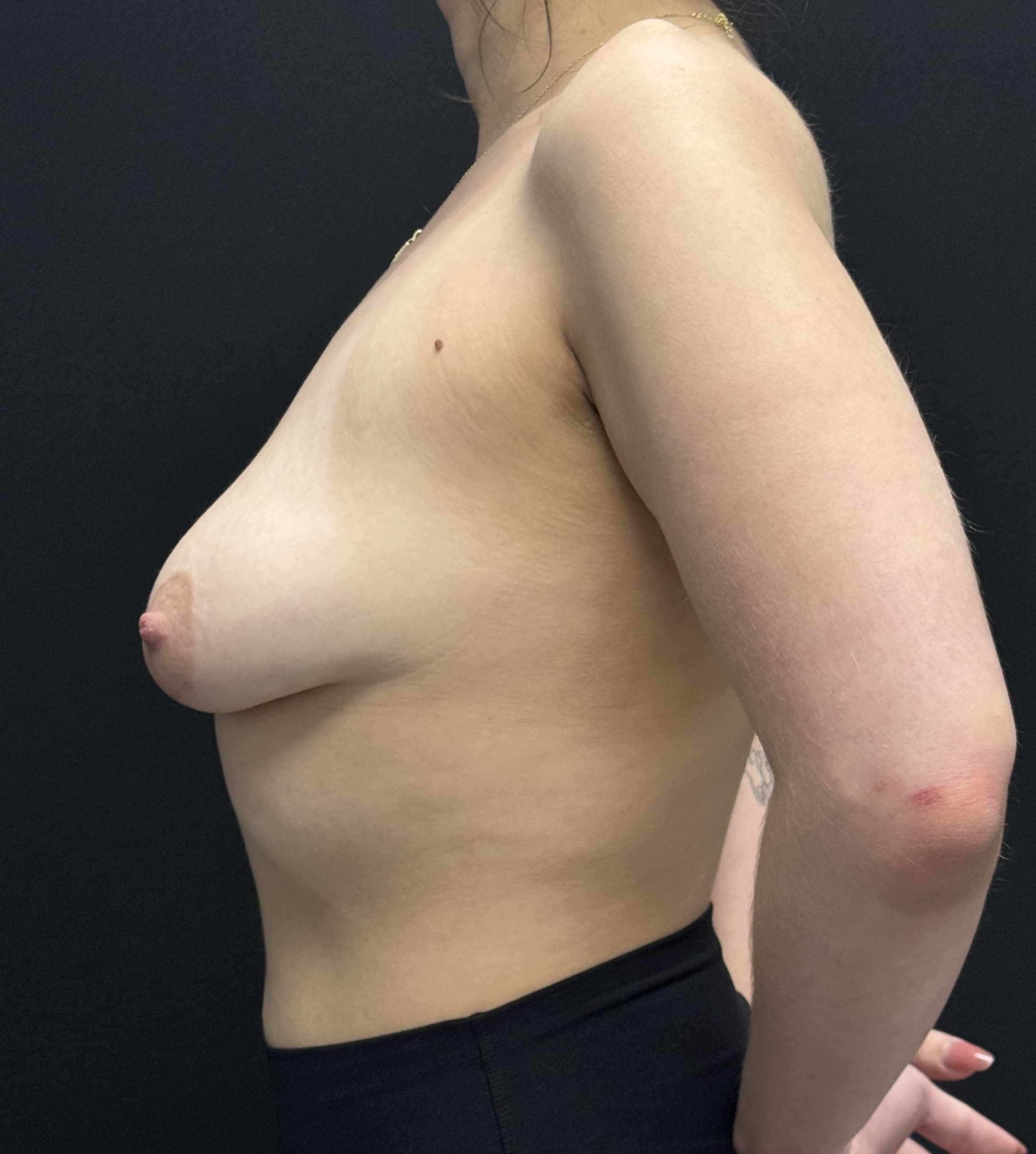 Breast Augmentation with Mastopexy Before - Patient 4927 - Left View