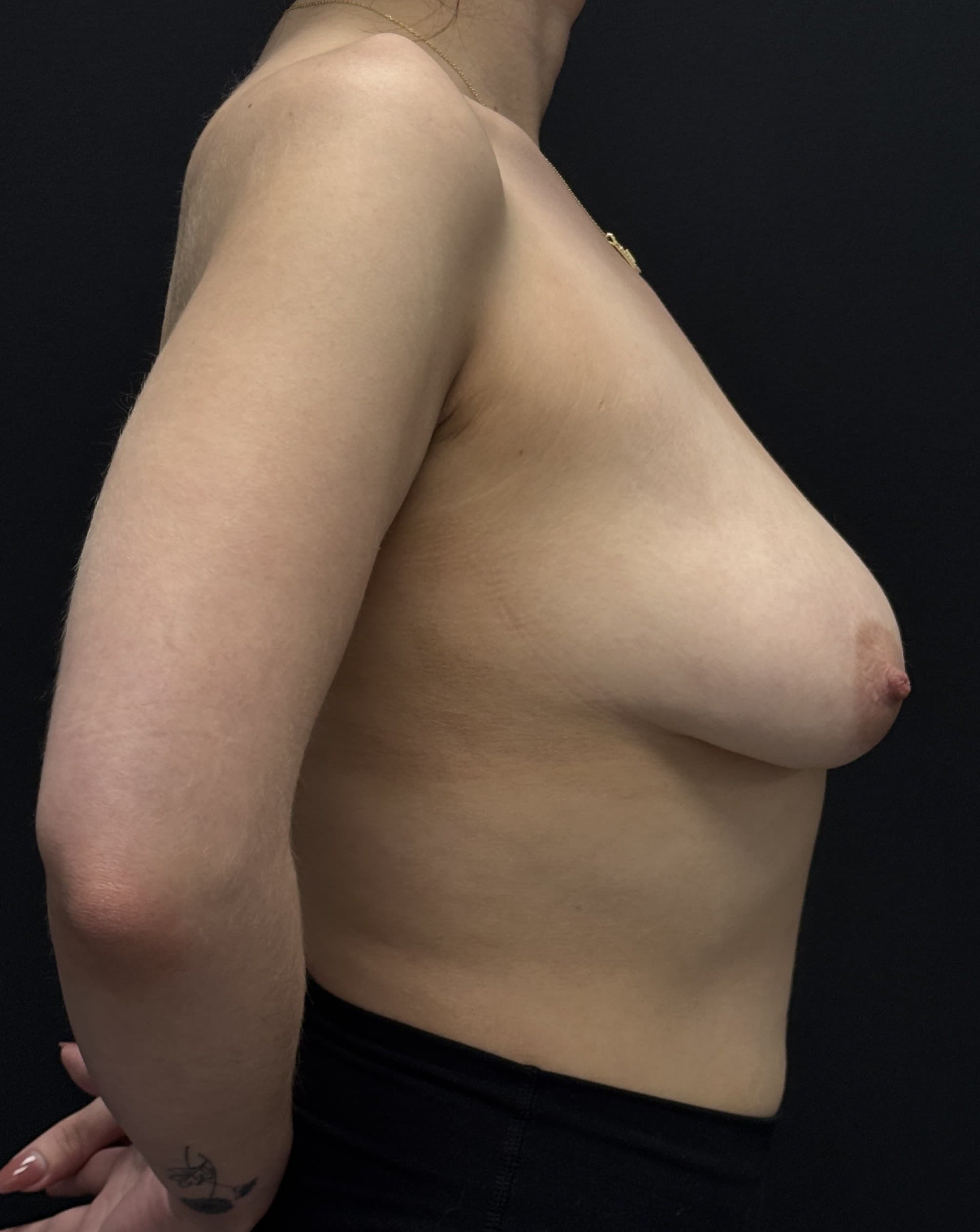 Breast Augmentation with Mastopexy Before - Patient 4927 - Right View