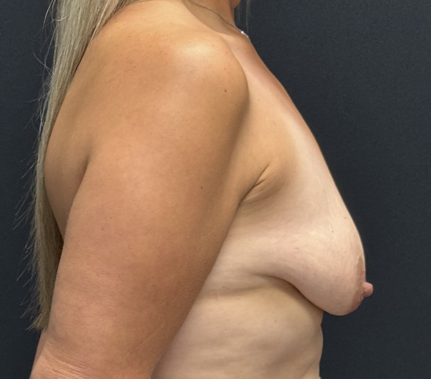 Breast Augmentation with Mastopexy Before - Patient 5288 - Right View