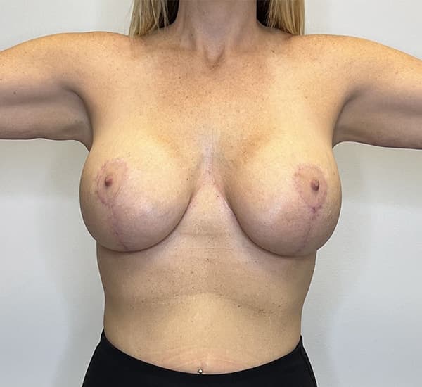Breast Augmentation with Mastopexy After - Patient 93879184 - Front View
