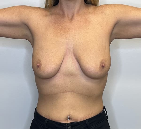 Breast Augmentation with Mastopexy Before - Patient 93879184 - Front View