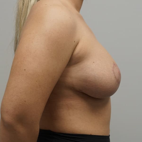 Breast Augmentation with Mastopexy After - Patient 93879213 - Right View