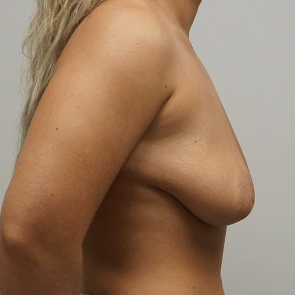Breast Augmentation with Mastopexy Before - Patient 93879213 - Right View