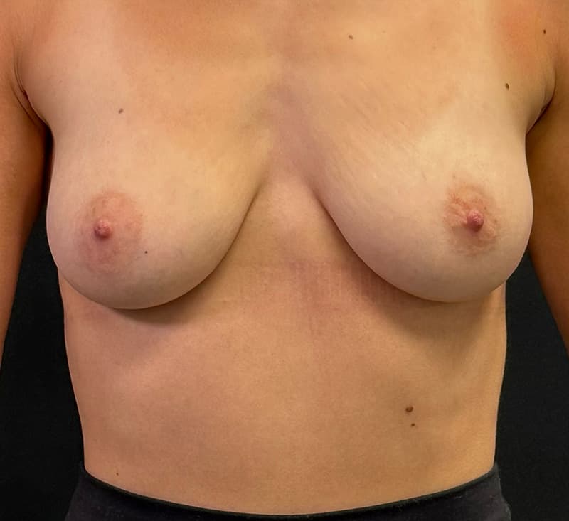 Breast Augmentation Before - Patient 100003 - Front View