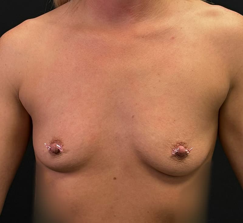 Breast Augmentation Before - Patient 124303 - Front View