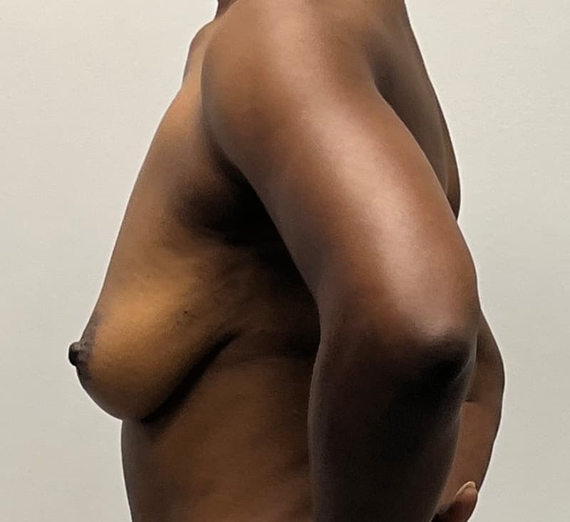Breast Augmentation Before - Patient 278457 - Left View